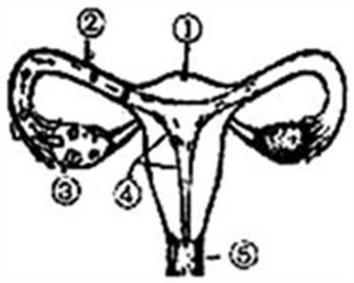多囊卵巢有什么症状和表现？适合做试管吗？